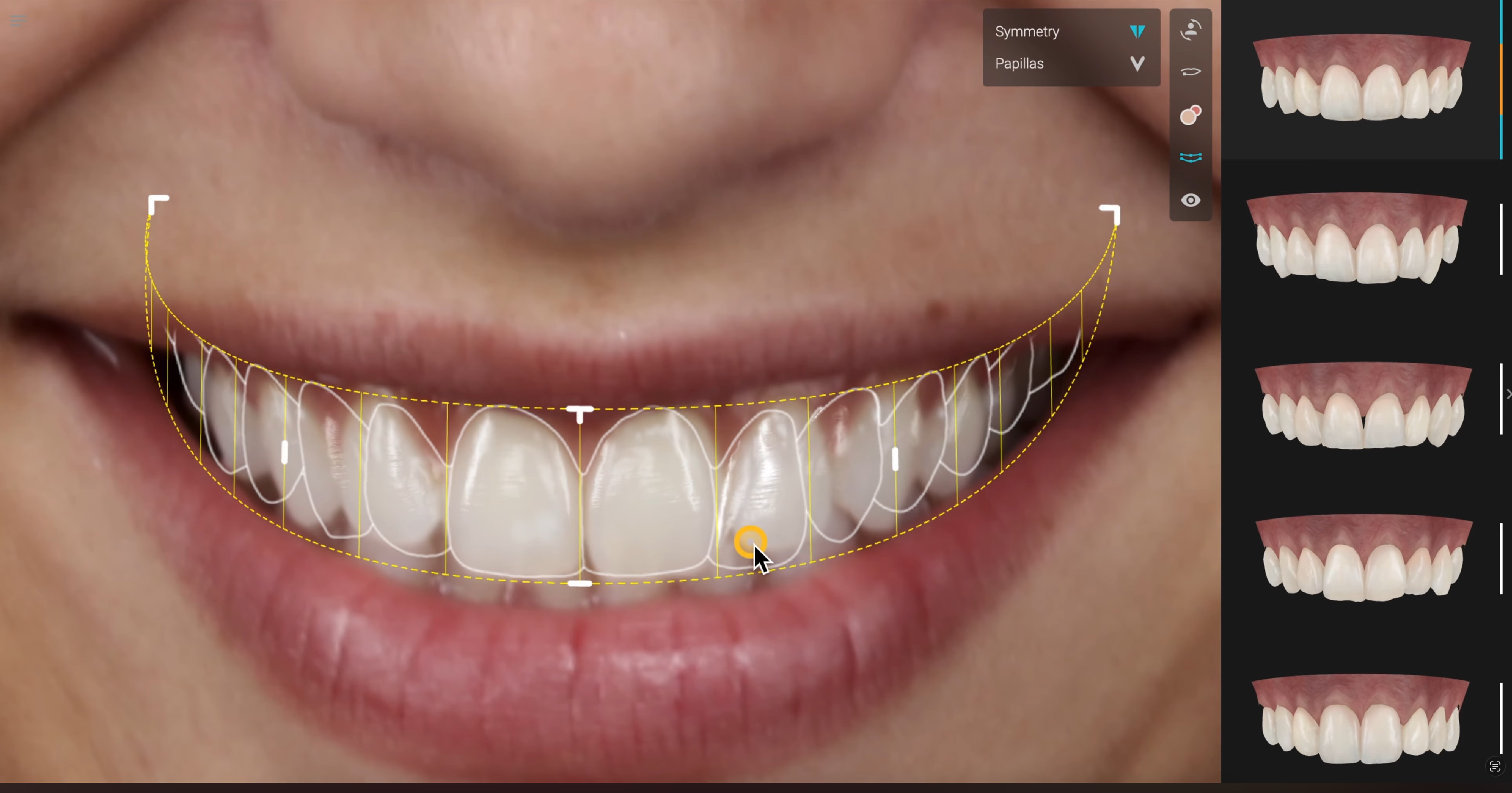 Planejamento virtual do sorriso com projeção digital dos dentes sobre a fotografia